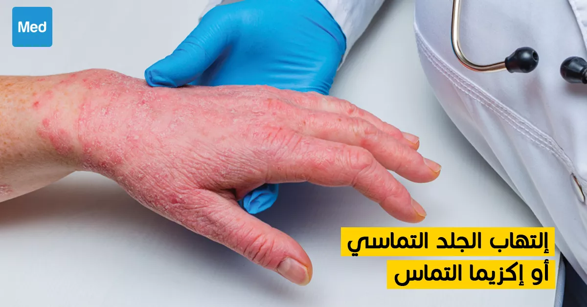 التهاب الجلد التماسي أو إكزيما التماس